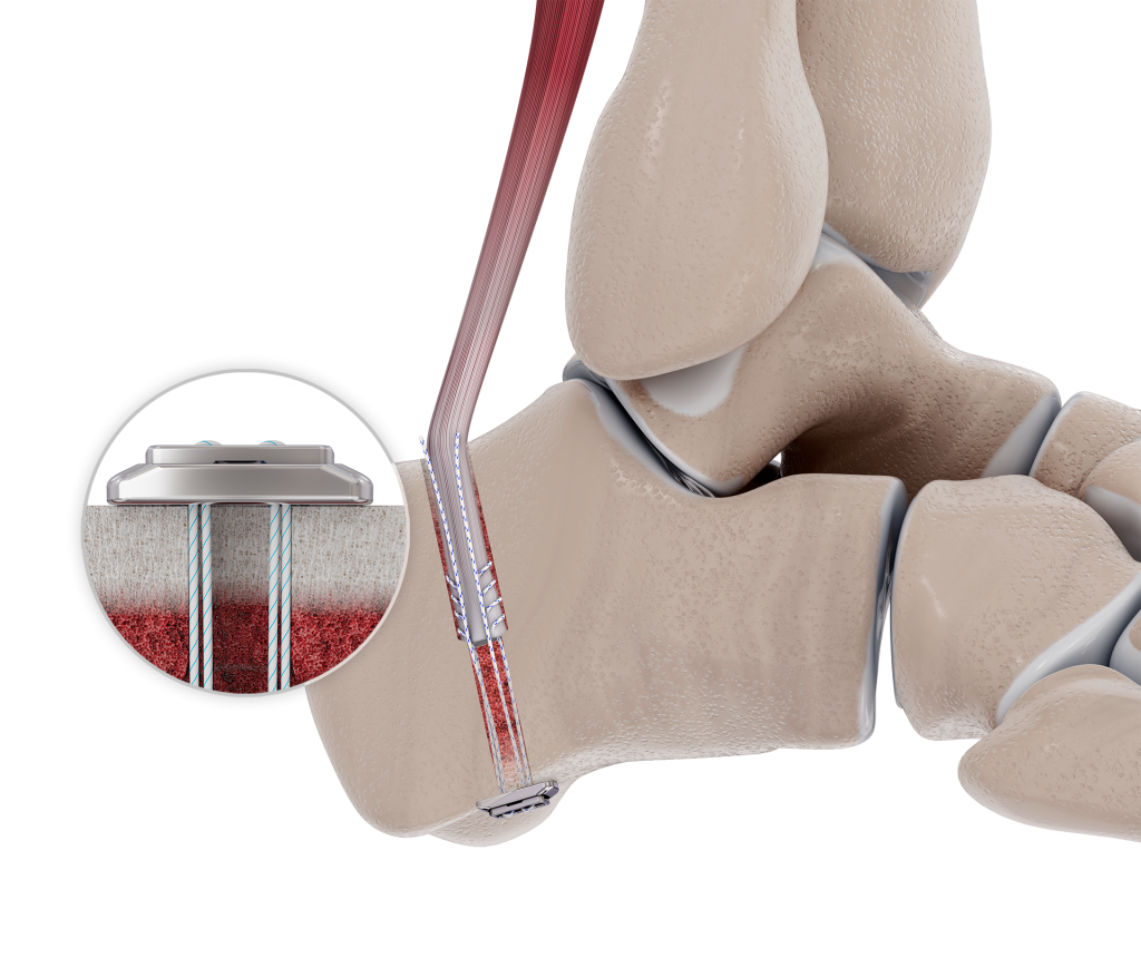 Chronic Achilles- FHL Tendon Transfer Knotless adjustable button