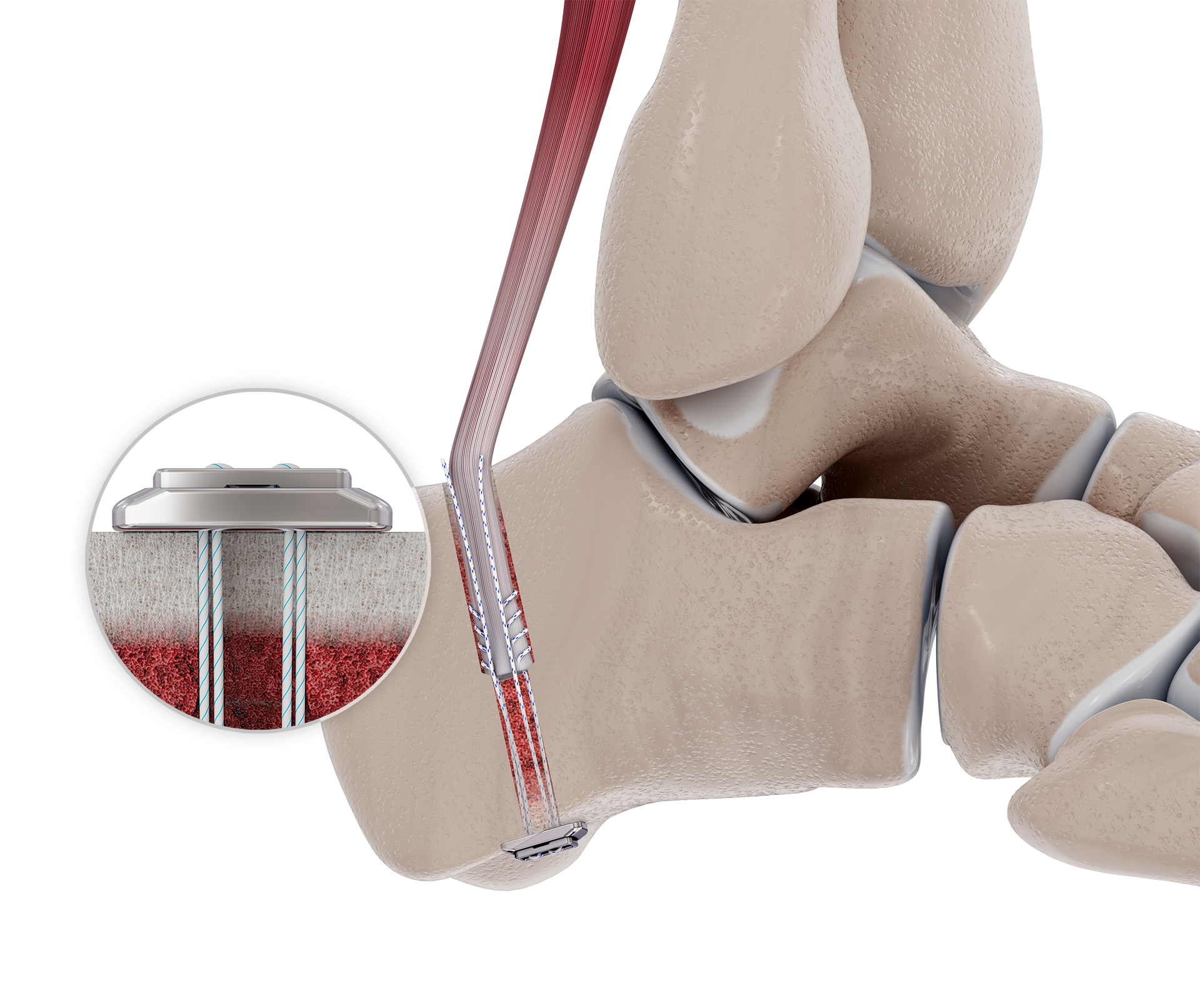 Chronic Achilles- FHL Tendon Transfer Knotless adjustable button